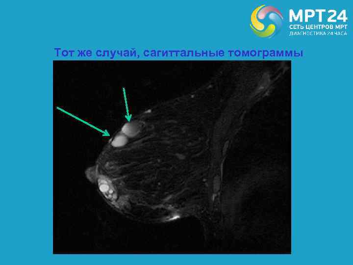 Тот же случай, сагиттальные томограммы 