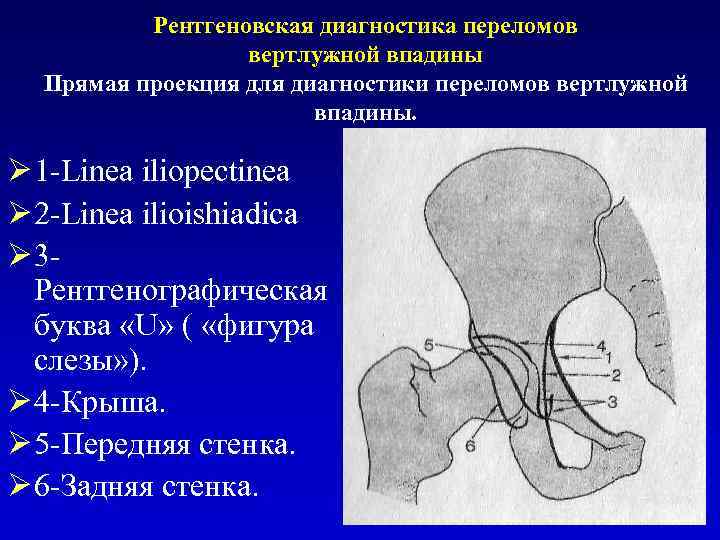 Рентгенологическая картина центрации головки бедра в пределах вертлужной впадины с обеих сторон