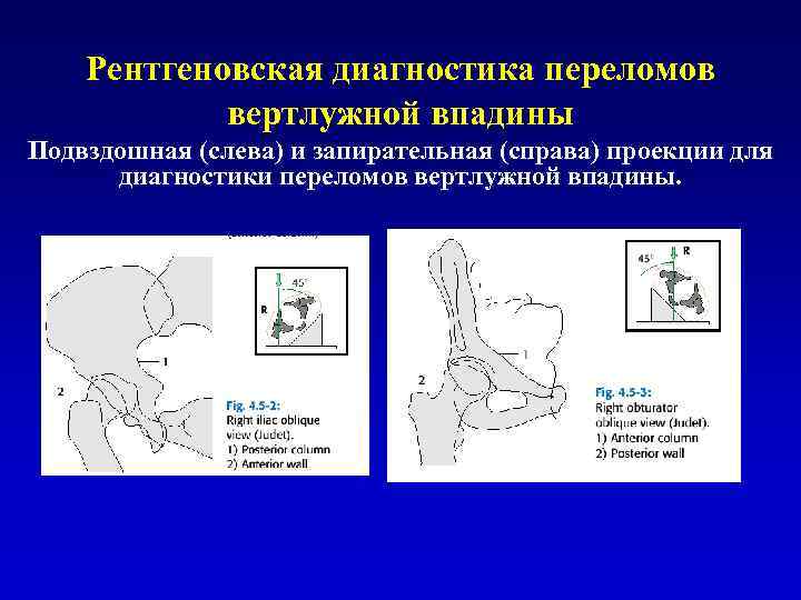 Диагностика переломов