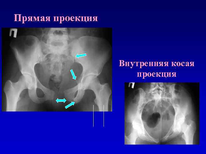 Проекция таза. Косая проекция. Косая проекция рентген. Рентгенограмма таза в косой проекции. Косая проекция в рентгенологии.