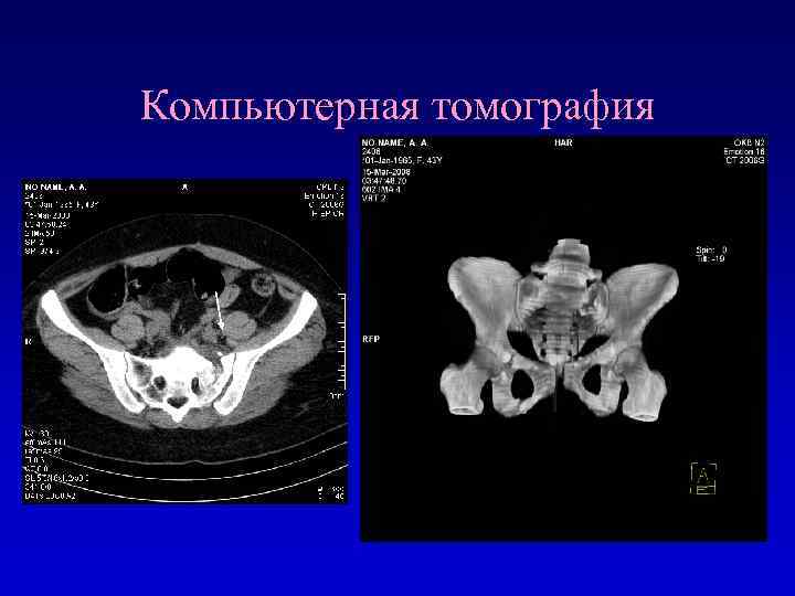 Кт костей. Компьютерная томография в травматологии. Компьютерная рентгеновская томография в травматологии. Кт в травматологии и ортопедии.