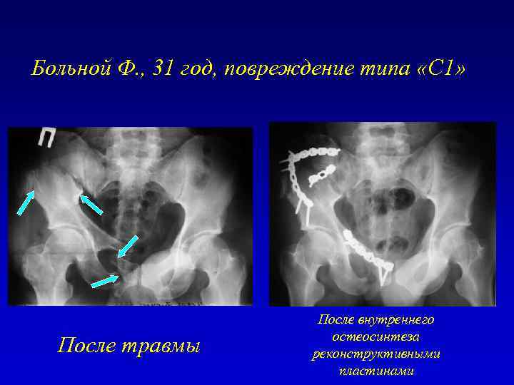 Травмы таза травматология презентация