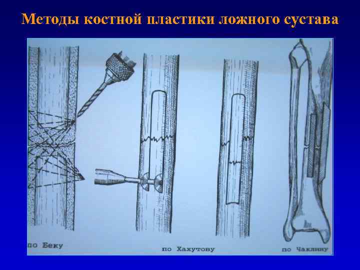 Регенерация костной ткани травматология презентация