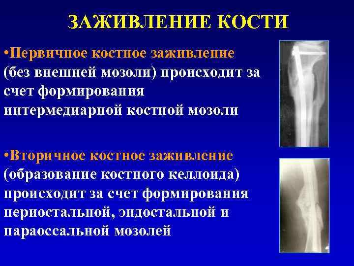 Сколько по времени заживает перелом. Регенерация костной ткани заживление консолидация. Стадии консолидации перелома на рентгене. Эндостальная костная мозоль на кт. Первичное заживление кости.
