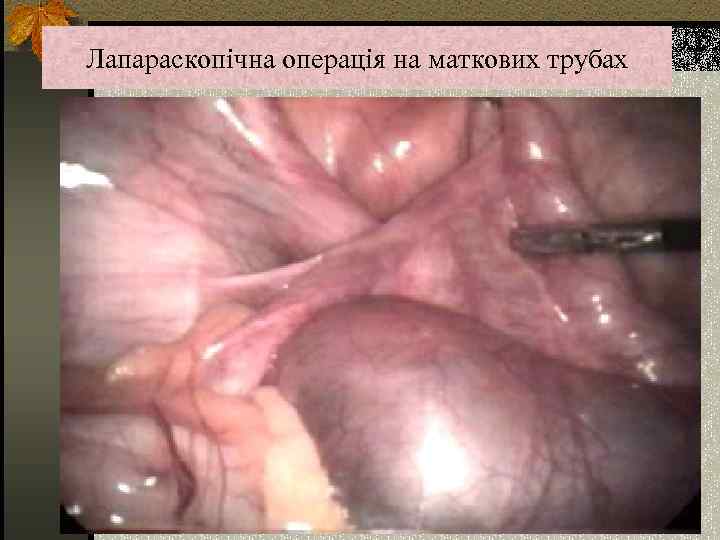 Лапараскопічна операція на маткових трубах 