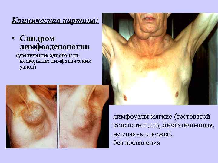 Клиническая картина: • Синдром лимфоаденопатии (увеличение одного или нескольких лимфатических узлов) лимфоузлы мягкие (тестоватой