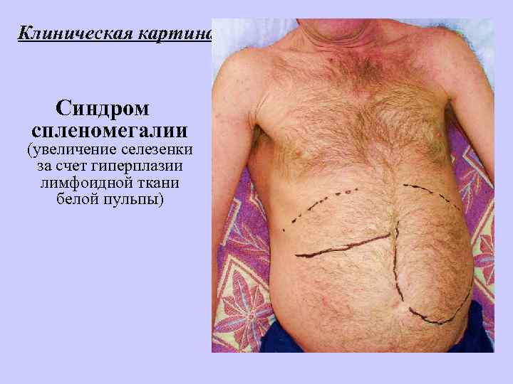Клиническая картина: Синдром спленомегалии (увеличение селезенки за счет гиперплазии лимфоидной ткани белой пульпы) 