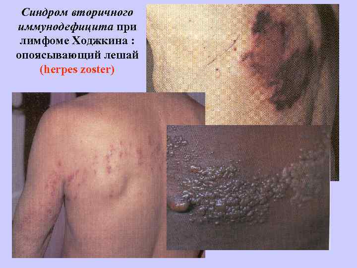 Синдром вторичного иммунодефицита при лимфоме Ходжкина : опоясывающий лешай (herpes zoster) 