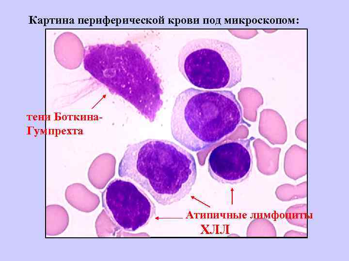 Реактивные лимфоциты в крови. Тени Боткина Гумпрехта мазок крови. Клетки Боткина Гумпрехта это. Тениботкина гумперхта в крови. Клетки Боткина Гумпрехта лейколиза.