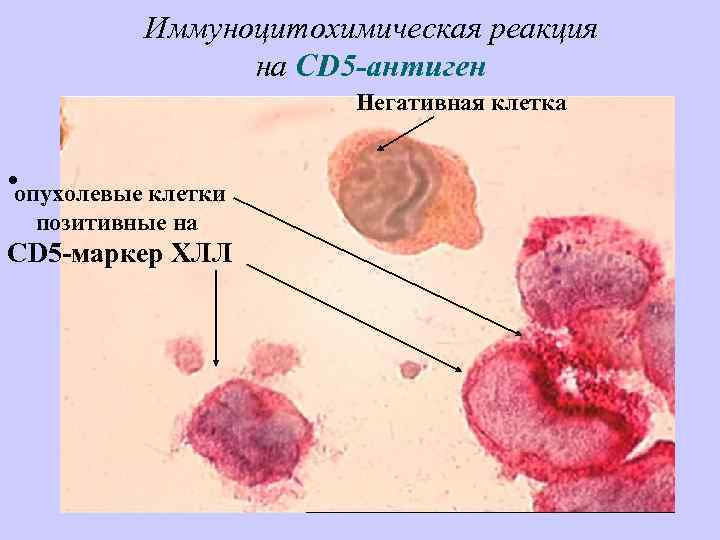 Хронический лимфолейкоз картинки