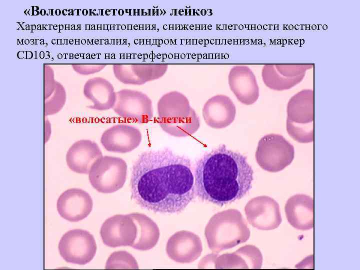 Патогенез хронического лимфолейкоза схема