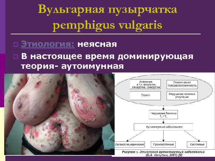 Вульгарная пузырчатка pemphigus vulgaris Этиология: неясная p В настоящее время доминирующая теория- аутоимунная p