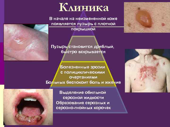 Клиника В начале на неизмененной коже появляется пузырь с плотной покрышкой Пузырь становится дряблый,