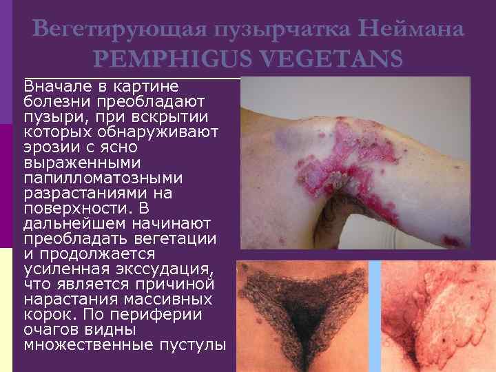 Вегетирующая пузырчатка Неймана PEMPHIGUS VEGETANS Вначале в картине болезни преобладают пузыри, при вскрытии которых