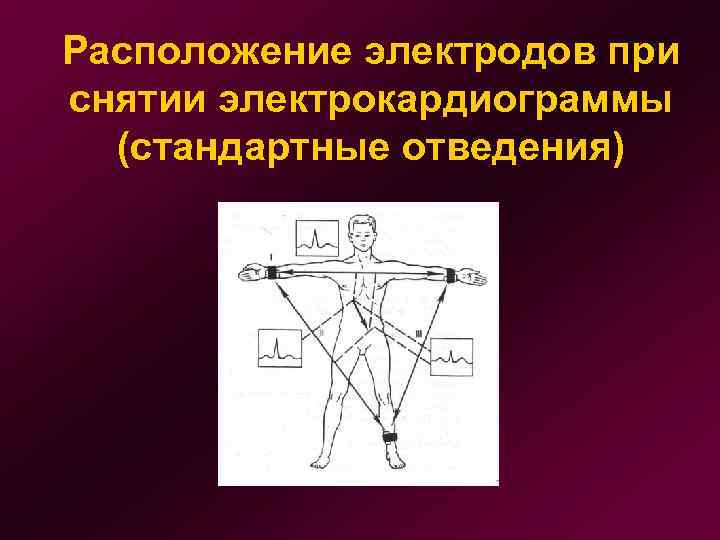 Расположение электродов при снятии электрокардиограммы (стандартные отведения) 