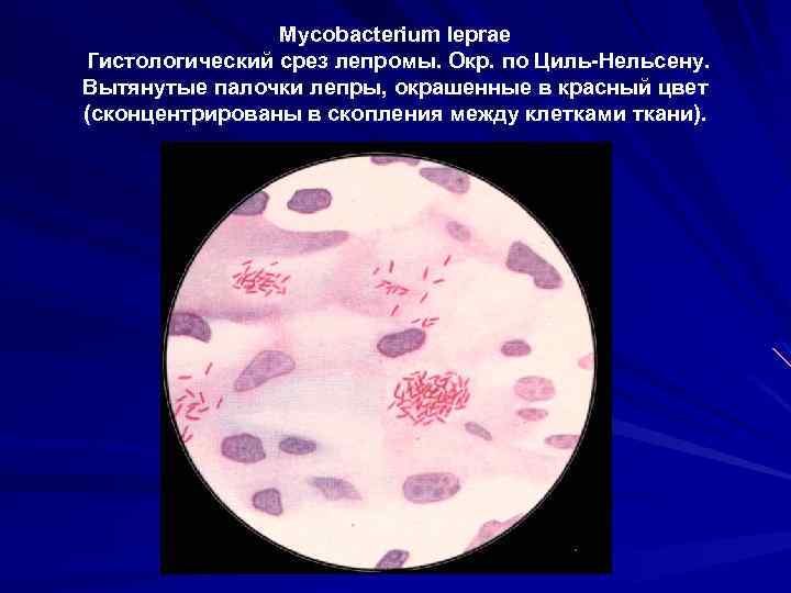Mycobacterium leprae Гистологический срез лепромы. Окр. по Циль-Нельсену. Вытянутые палочки лепры, окрашенные в красный