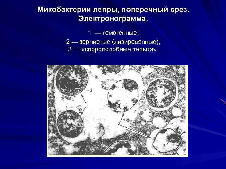 Микобактерии лепры, поперечный срез. Электронограмма. 1 — гомогенные; 2 — зернистые (лизированные); 3 —