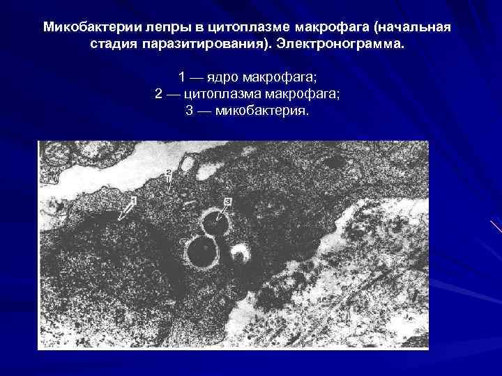 Микобактерии лепры в цитоплазме макрофага (начальная стадия паразитирования). Электронограмма. 1 — ядро макрофага; 2