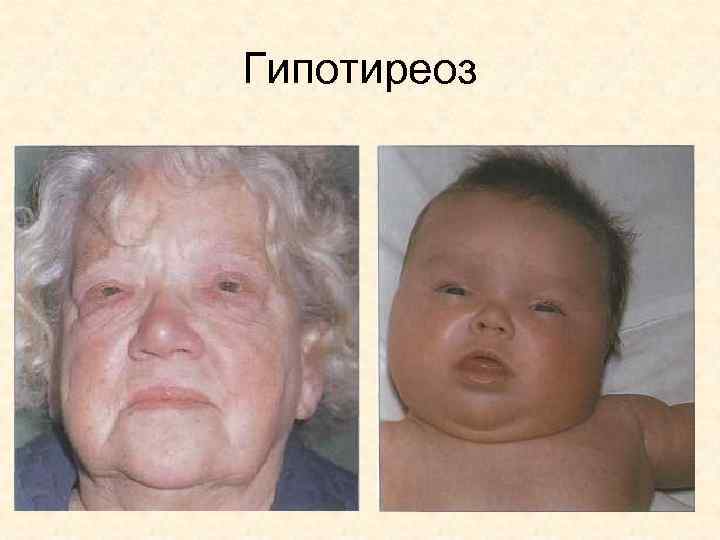 Гипотиреоз 