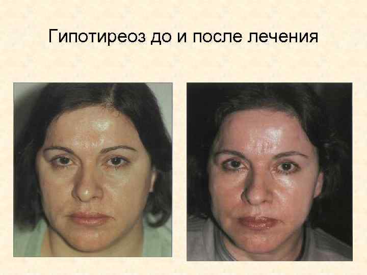 Гипотиреоз до и после лечения 