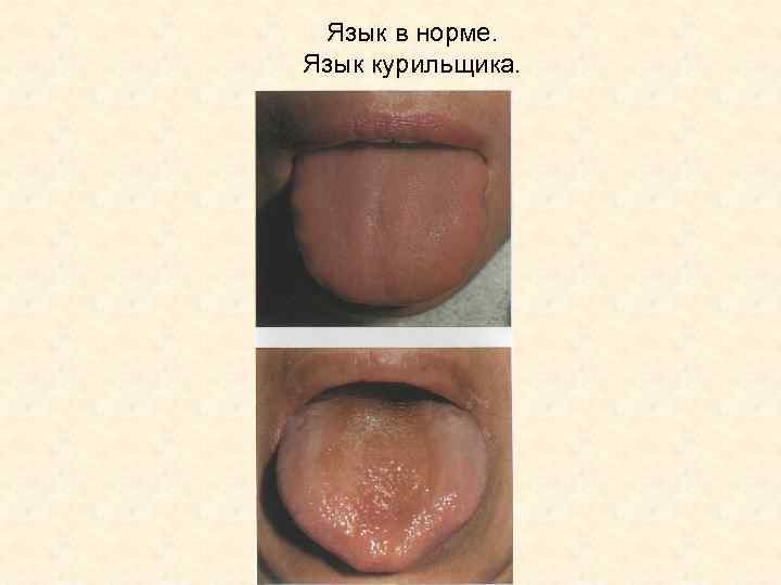 Язык в норме. Язык курильщика. 