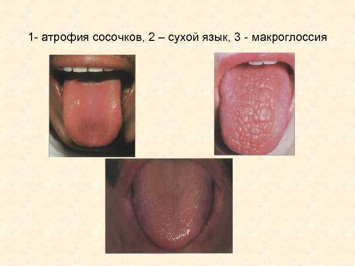 1 - атрофия сосочков, 2 – сухой язык, 3 - макроглоссия 