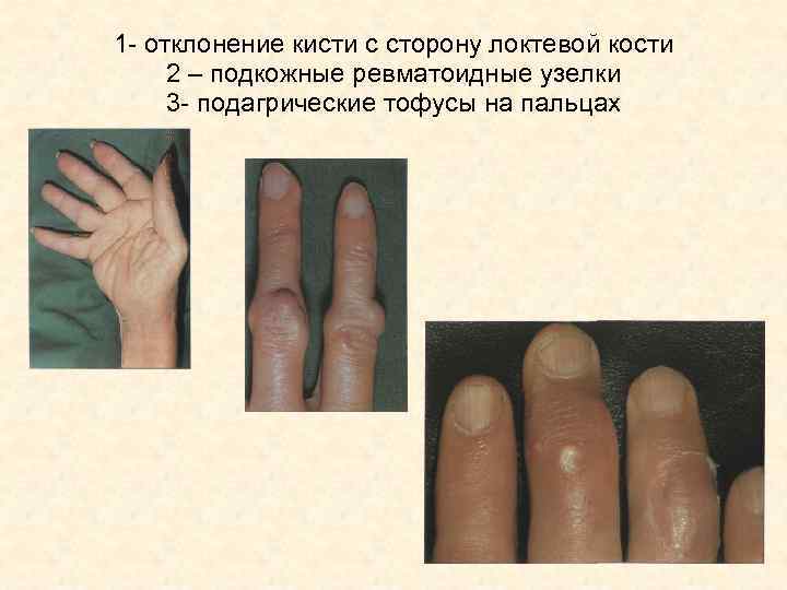 1 - отклонение кисти с сторону локтевой кости 2 – подкожные ревматоидные узелки 3