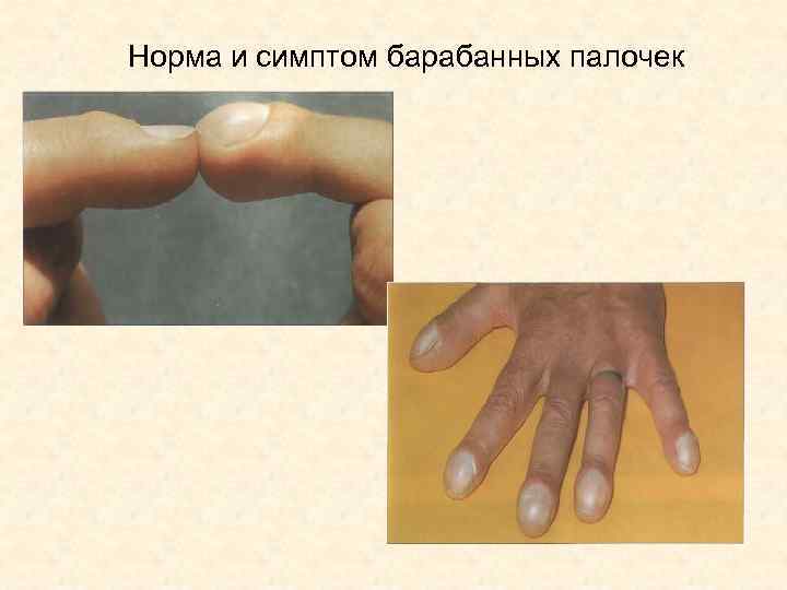 Норма и симптом барабанных палочек 