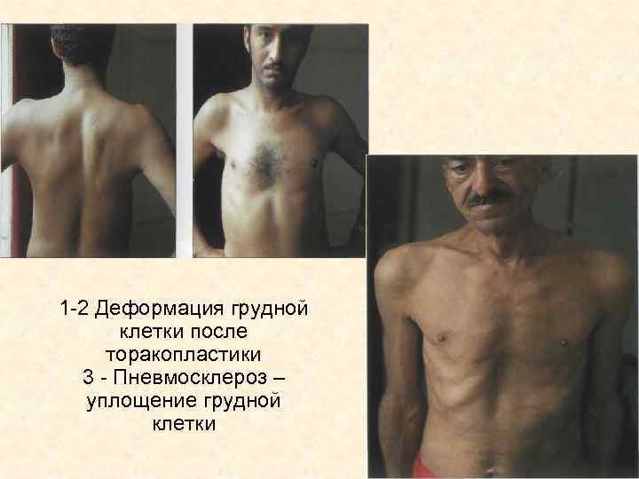 1 -2 Деформация грудной клетки после торакопластики 3 - Пневмосклероз – уплощение грудной клетки