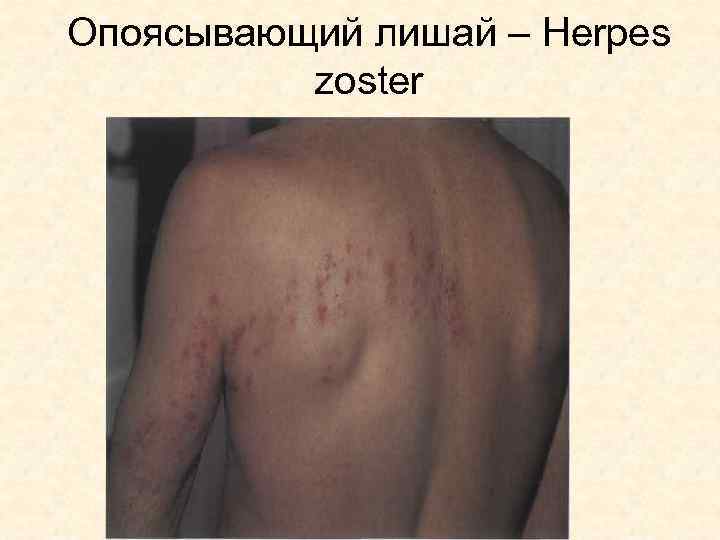 Опоясывающий лишай – Herpes zoster 