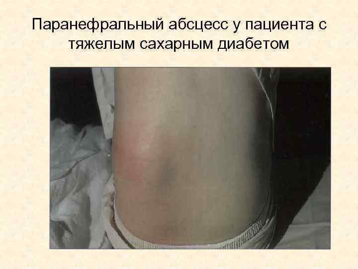 Паранефральный абсцесс у пациента с тяжелым сахарным диабетом 