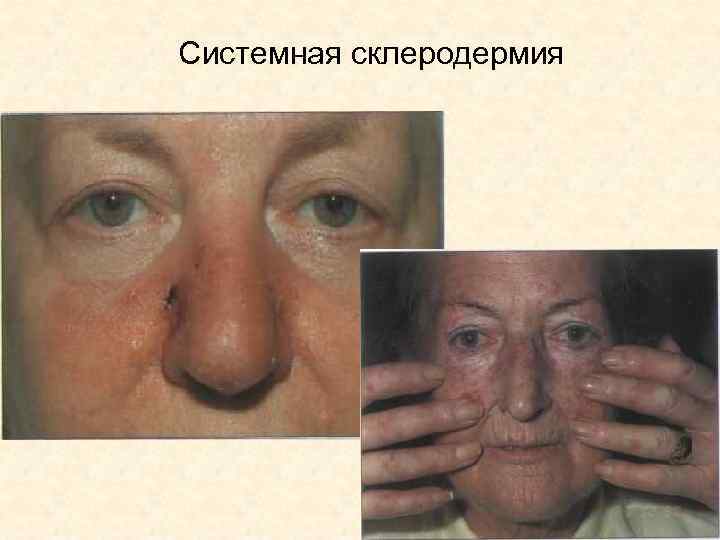 Системная склеродермия 