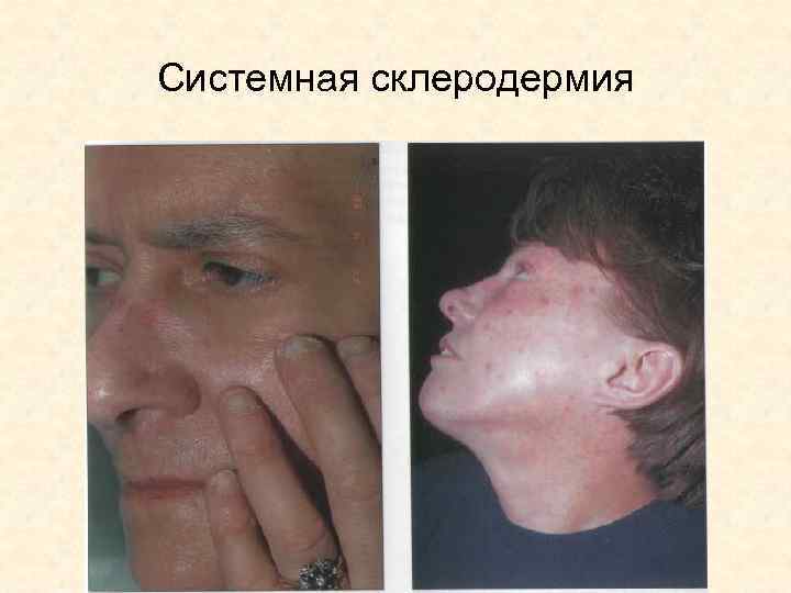 Системная склеродермия 