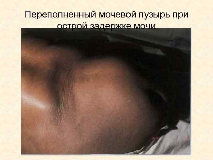 Переполненный мочевой пузырь при острой задержке мочи 
