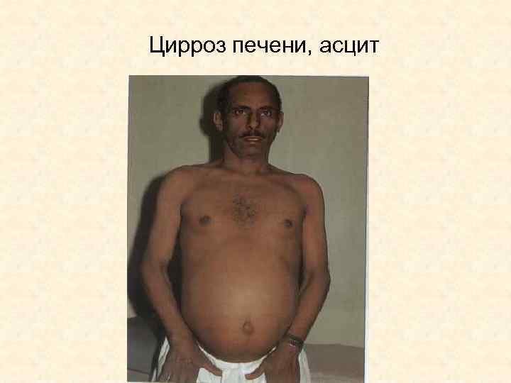 Цирроз печени, асцит 