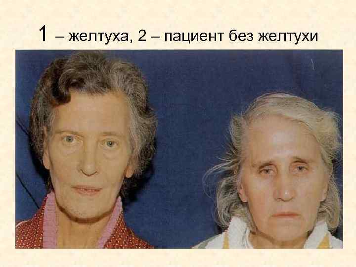 1 – желтуха, 2 – пациент без желтухи 