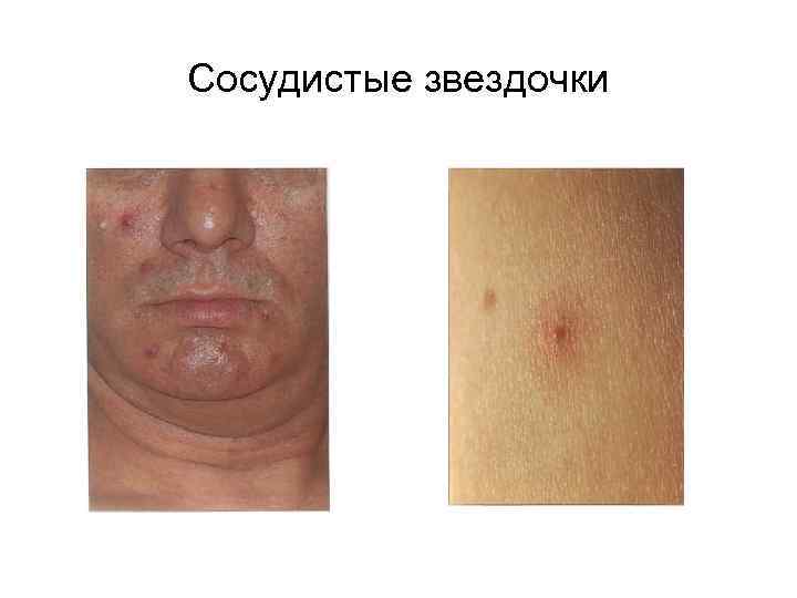 Сосудистые звездочки 