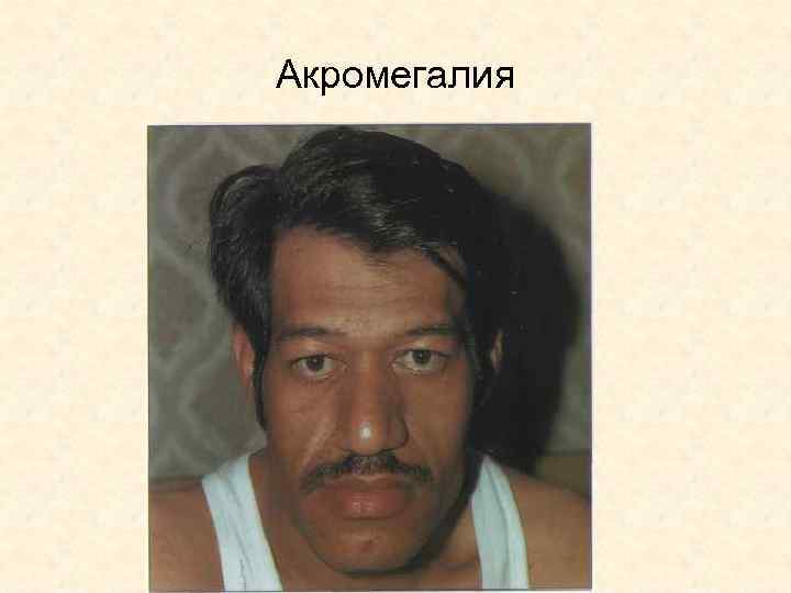 Акромегалия 
