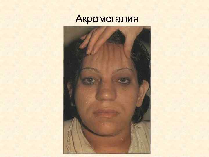 Акромегалия 