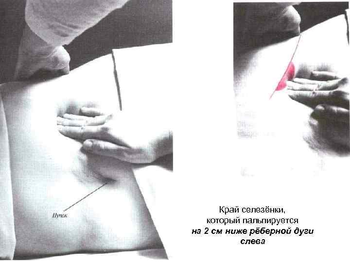 Край селезёнки, который пальпируется на 2 см ниже рёберной дуги слева 