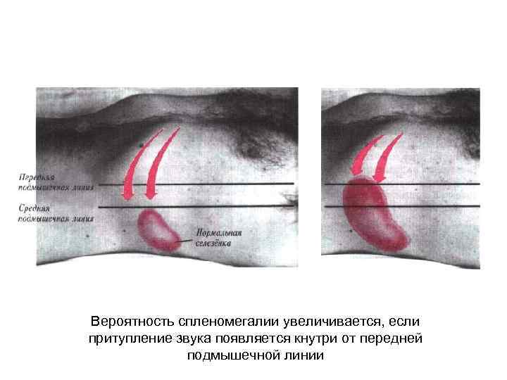 Вероятность спленомегалии увеличивается, если притупление звука появляется кнутри от передней подмышечной линии 