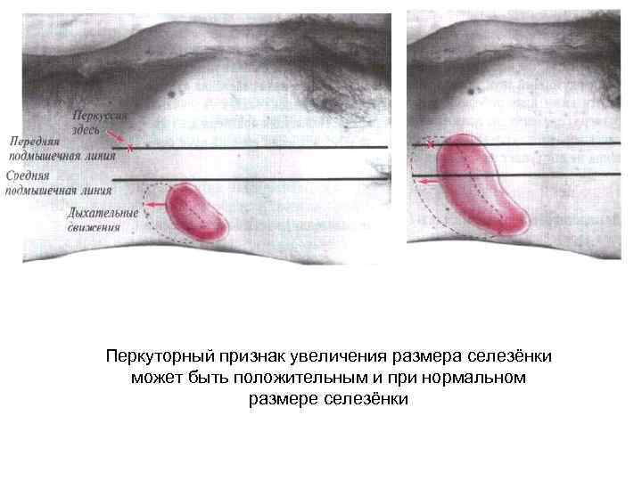 Перкуторный признак увеличения размера селезёнки может быть положительным и при нормальном размере селезёнки 
