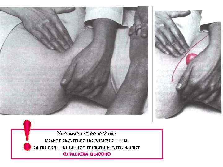 Увеличение селезёнки может остаться не замеченным, если врач начинает пальпировать живот слишком высоко 