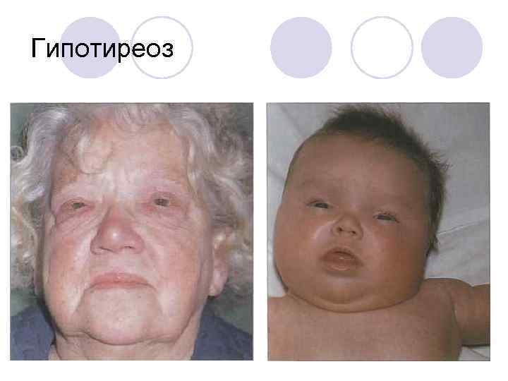 Гипотиреоз 