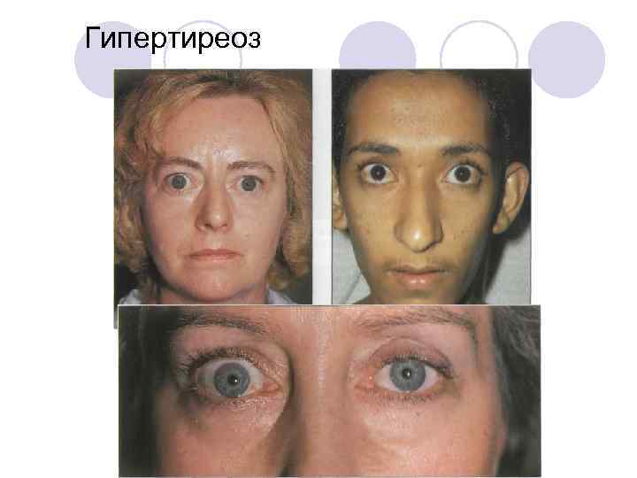 Гипертиреоз 