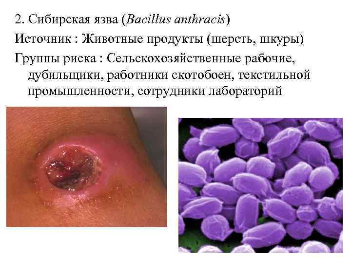 2. Сибирская язва (Bacillus anthracis) Источник : Животные продукты (шерсть, шкуры) Группы риска :
