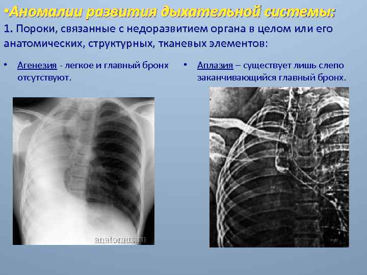 Врожденные пороки развития дыхательной системы презентация