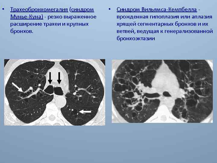  • Трахеобронхомегалия (синдром Мунье-Куна) - резко выраженное расширение трахеи и крупных бронхов. •