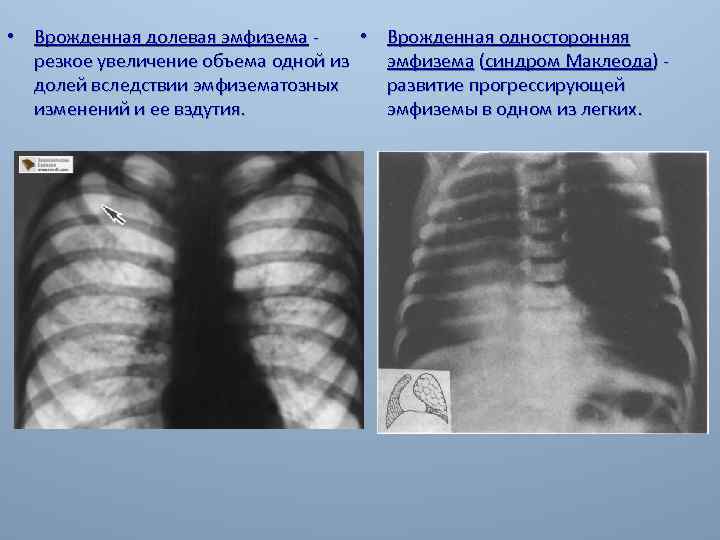 Врожденная лобарная эмфизема клиника рентгенологическая картина принципы лечения