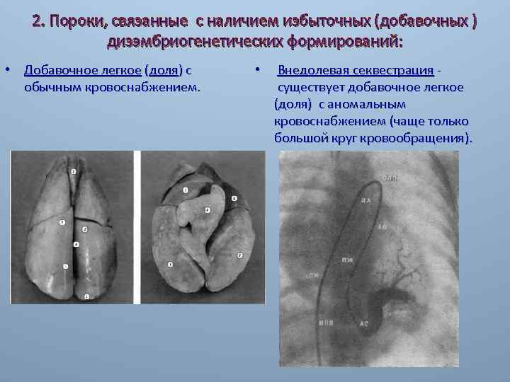 2. Пороки, связанные с наличием избыточных (добавочных ) дизэмбриогенетических формирований: • Добавочное легкое (доля)